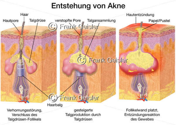 Akne (Mitesser), Erkrankung von Talgdrüsen und Haarfollikel - Medical Pictures