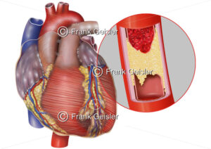 Anatomie Herz, Herzinfarkt durch Arteriosklerose in Koronararterie - Medical Pictures