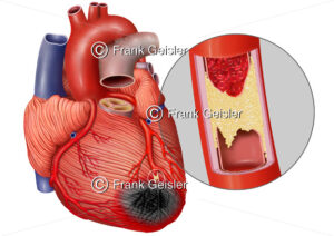 Anatomie Herz, Herzinfarkt durch Arteriosklerose in Koronararterie - Medical Pictures