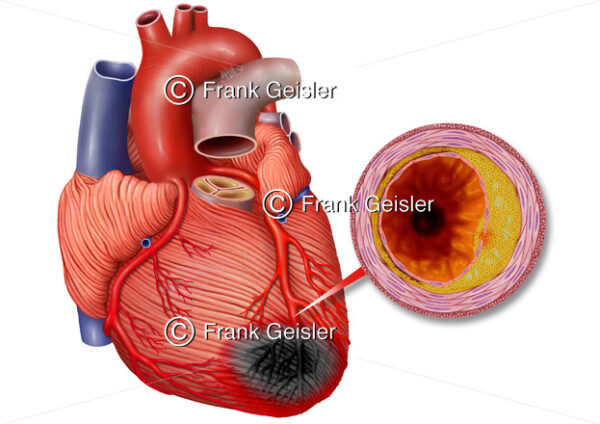 Anatomie Herz, Myokardinfarkt durch Arteriosklerose in Koronararterie - Medical Pictures