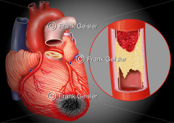 Anatomie Herz, Myokardinfarkt durch Arteriosklerose in Koronararterie - Medical Pictures