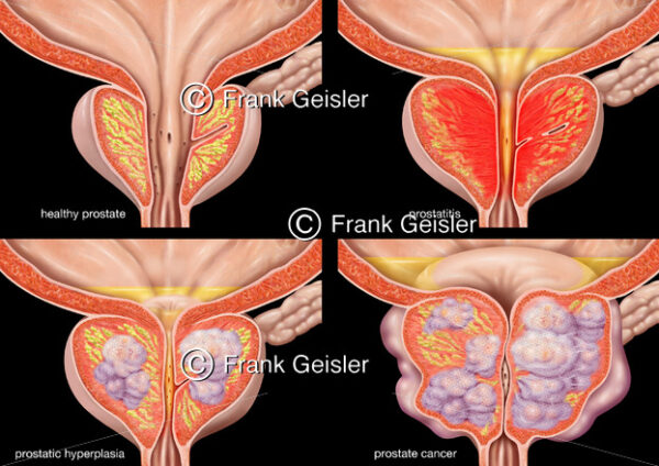 Anatomie Vorsteherdrüse Prostata, Drüsengewebe mit Prostatitis, benigne Prostatahyperplasie BPH und Prostatakarzinom PCa - Medical Pictures