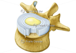 Anatomie Wirbelknochen und Bandscheibe mit Faserring und Gallertkern - Medical Pictures