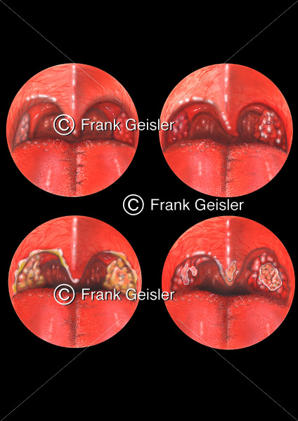 Anginen, Mandelentzündung (Tonsillitis, Angina tonsillaris) der Rachenmandel (Tonsilla pharyngealis) - Medical Pictures