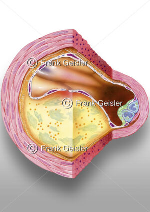 Arterie mit Arteriosklerose (Atherosklerose), Histologie Wandaufbau - Medical Pictures