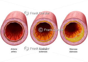 Arterie mit Sklerose und Stenose durch Arteriosklerose Ablagerungen - Medical Pictures