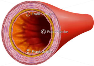 Arteriosklerose der Arterie mit Ablagerungen in der Intima, Intimasklerose der Arterienwand - Medical Pictures