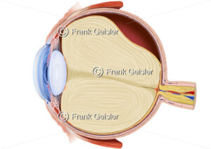 Augapfel (Bulbus oculi) mit Netzhautablösung (Ablatio, Amotio retinae) - Medical Pictures