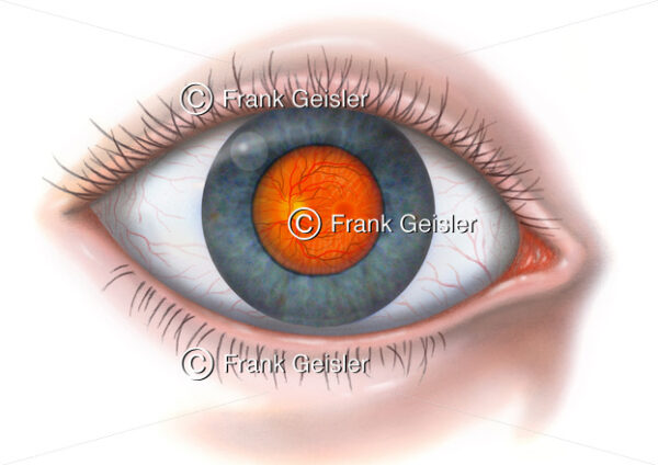 Auge mit Augenhintergrund in Pupille (Sehloch) sichtbar - Medical Pictures