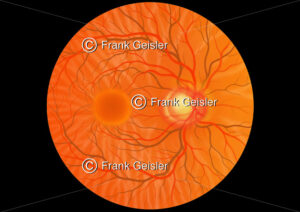 Augenhintergrund (Fundus oculi) mit Glaukom (Grüner Star) - Medical Pictures