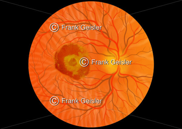 Augenhintergrund mit feuchte Makuladegeneration der Macula lutea (Gelber Fleck) - Medical Pictures