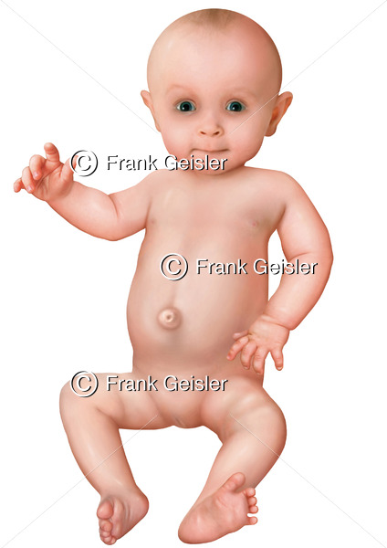 Baby mit Nabelbruch, Nabelhernie, Umbilicalhernie, Hernia umbilicalis am Nabel - Medical Pictures
