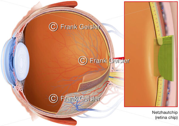 Bionik in der Augenheilkunde, Netzhautchip in beschädigter Retina - Medical Pictures