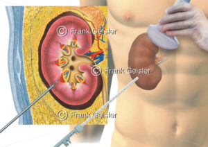 Biopsie der Niere, Entnahme Gewebeproben bei Verdacht auf Nierenzellkarzinom - Medical Pictures