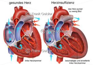 Blutfluss gesundes Herz und bei Herzinsuffizienz der linken Herzkammer - Medical Pictures