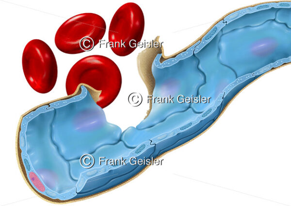 Blutgefäße, defekte Wand der Blutkapillare mit Epithelzellen - Medical Pictures