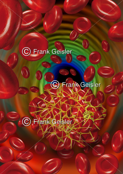 Blutgerinnsel im Blutgefäß, Bildung Thrombus durch intravasale Gerinnung im Blutkreislauf - Medical Pictures