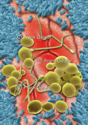 Darmflora auf der Darmschleimhaut, Mukosa mit pathogene Mykoflora der Intestinalflora - Medical Pictures