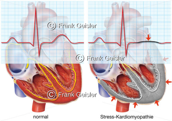 EKG bei Stress-Kardiomyopathie (Broken-Heart-Syndrom) - Medical Pictures