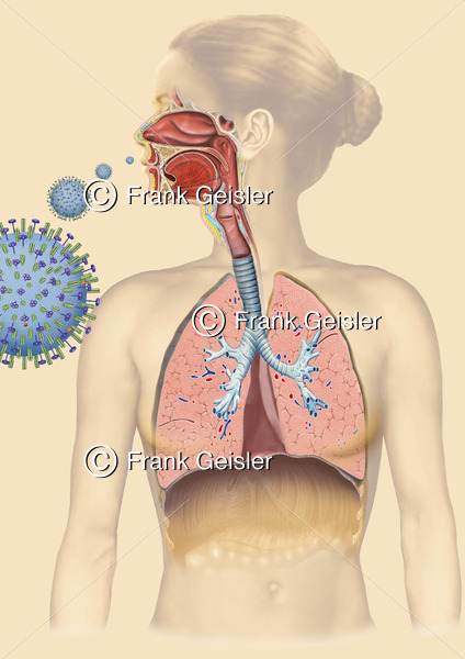 Echte Grippe durch Influenza-Infektion - Medical Pictures
