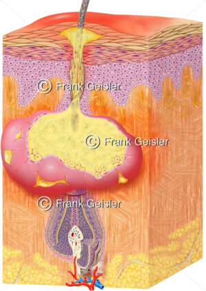 Entzündung bei Akne (Mitesser), Erkrankung von Talgdrüsen und Haarfollikel - Medical Pictures