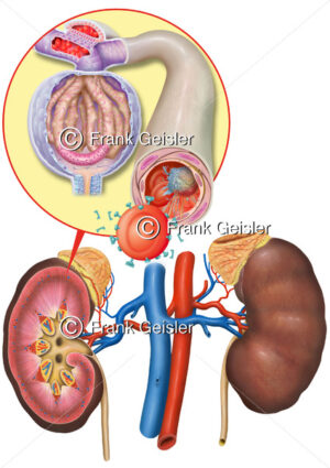 Entzündung der Harnwege, Sepsie bei Filtration in Nierenkörperchen - Medical Pictures