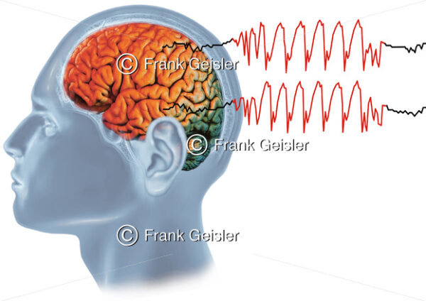 Epilepsie, generalisierter epileptischer Anfall - Medical Pictures