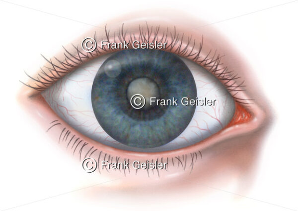 Erkrankung Auge, die Katarakt (Grauer Star) der Augenlinse - Medical Pictures
