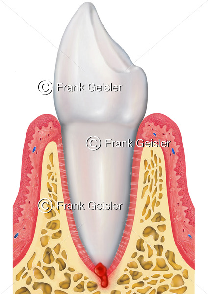 Erkrankung Zahn durch Zahnwurzelzyste, Kieferzyste an der Zahnwurzel - Medical Pictures