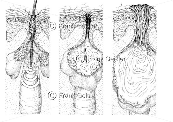 Erkrankung der Haut , Veränderung der Talgdrüse bei Akne - Medical Pictures