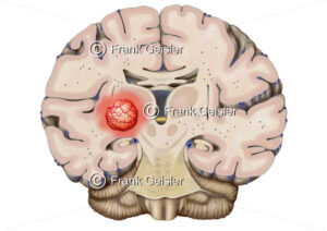 Frontalschnitt durch ein Gehirn, Mittelhirn mit Hirntumor - Medical Pictures