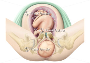 Geburt, Durchtritt durch den Geburtskanal, Kopf des Babys drängt durch Vulva - Medical Pictures