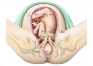 Geburt, Durchtritt durch den Geburtskanal, Kopf des Babys erscheint - Medical Pictures