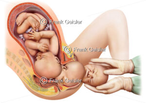Geburt, Geburtsvorgang im Geburtskanal der Mutter - Medical Pictures