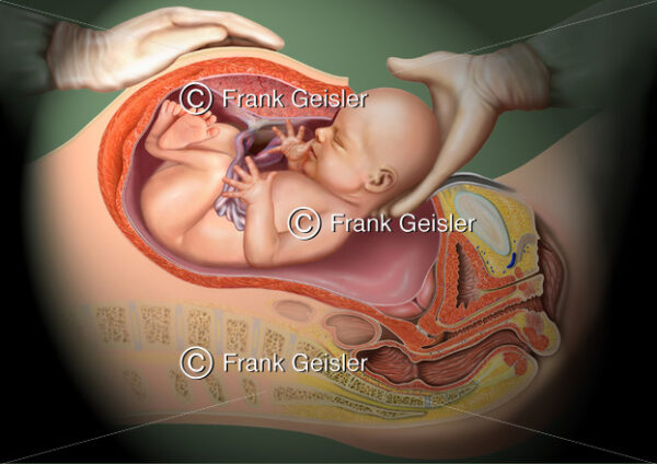 Geburt durch Kaiserschnitt, Schnittentbindung - Medical Pictures