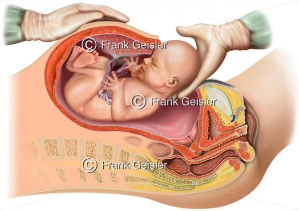 Geburt durch Kaiserschnitt, Schnittentbindung - Medical Pictures