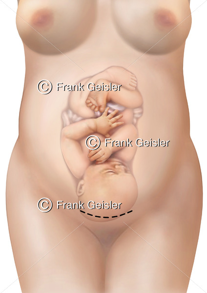 Geburt durch Kaiserschnitt, Schnittentbindung Pfannenstielschnitt - Medical Pictures