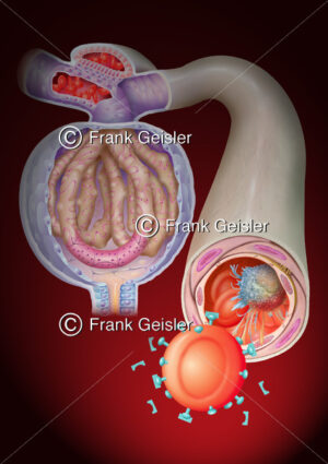 Harnwegsentzündung, Sepsie bei Filtration in Nierenkörperchen - Medical Pictures