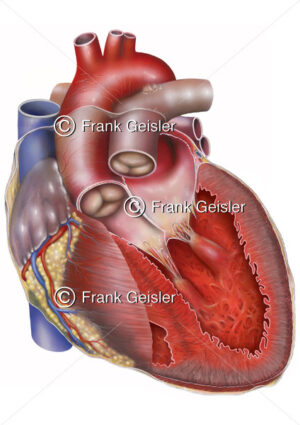 Herz mit Herzinsuffizienz (Herzschwäche, Herzmuskelschwäche) - Medical Pictures