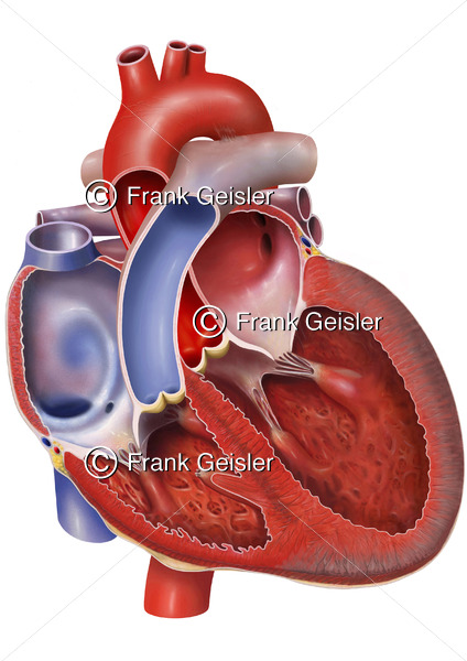 Herz mit Herzinsuffizienz, Herzschwäche durch Schwäche Herzmuskel der linken Herzkammer - Medical Pictures