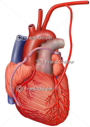 Herz mit Herzkranzgefäße, Blutumleitung mittels Bypass - Medical Pictures