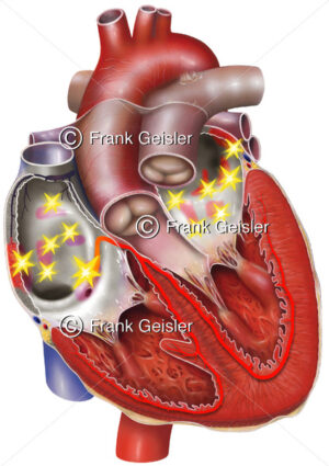 Herz mit Herzrhythmusstörung Vorhofflimmern (Herzvorhofflimmern) - Medical Pictures