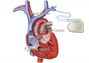 Herz mit Herzschrittmacher bei Bradykardie - Medical Pictures