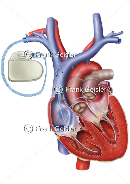Herz mit Herzschrittmacher, ein Herzinsuffizienz-Therapiesystem - Medical Pictures