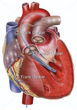 Herz mit Minipumpe, Herzpumpe bei Herzinsuffizienz - Medical Pictures