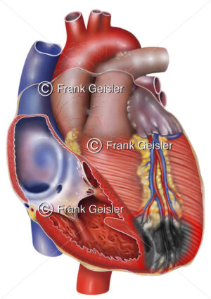 Herz mit Myokardinfarkt (Herzinfarkt, Herzmuskelinfarkt) - Medical Pictures