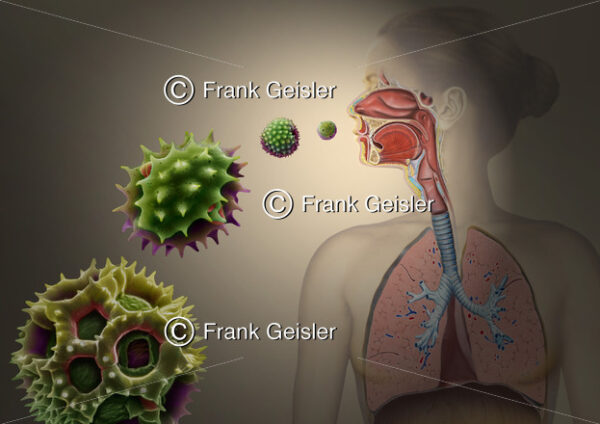 Heuschnupfen durch Pollenallergie, allergische Reaktionen der Atemwege durch Pollen - Medical Pictures