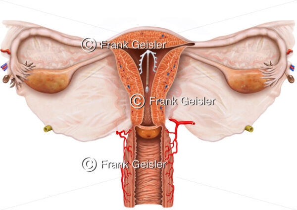 Intrauterinpessar (IUP) zur Empfängnisverhütung (Kontrazeption) der Frau - Medical Pictures