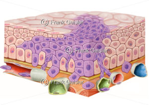 Karzinogenese, Tumorwachstum, Schleimhautepithel mit invasivem Karzinom - Medical Pictures