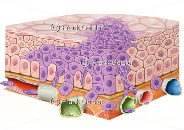 Karzinogenese, Tumorwachstum, Schleimhautepithel mit invasivem Karzinom - Medical Pictures